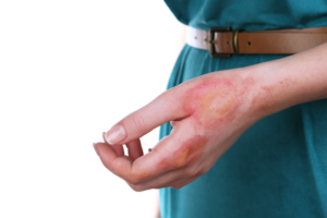 burn accident at work claims guide 