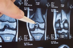 knee injury at work compensation